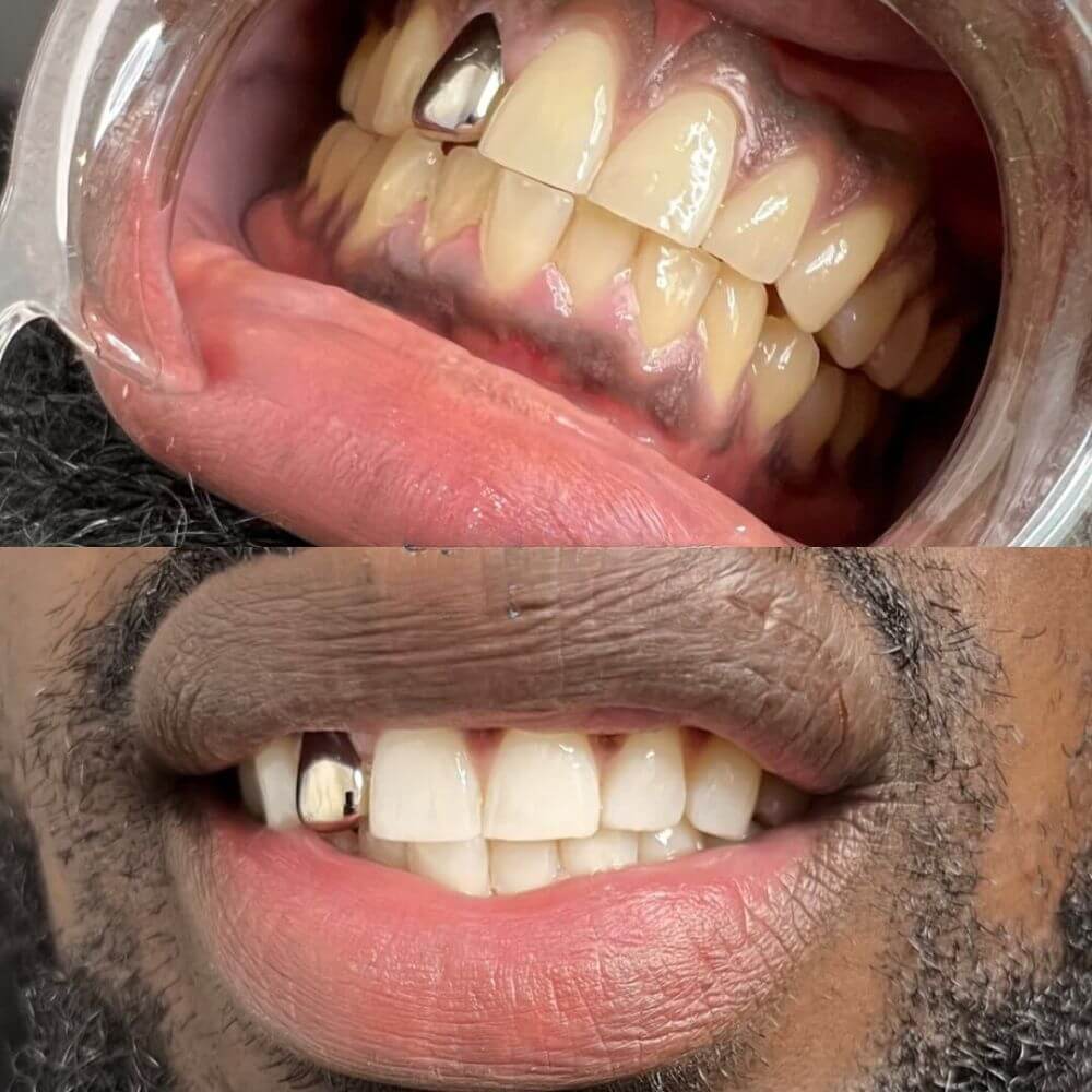 LOVILDS® | Whitening Strips